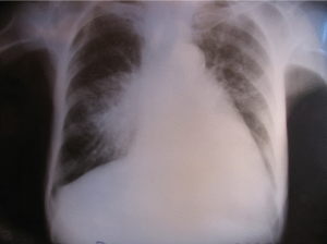 Tumora bronho-pulmonara dreapta